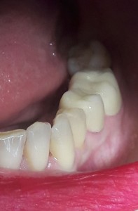 2 elementi in zirconia