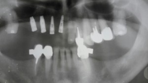protesi-dentaria-pg  